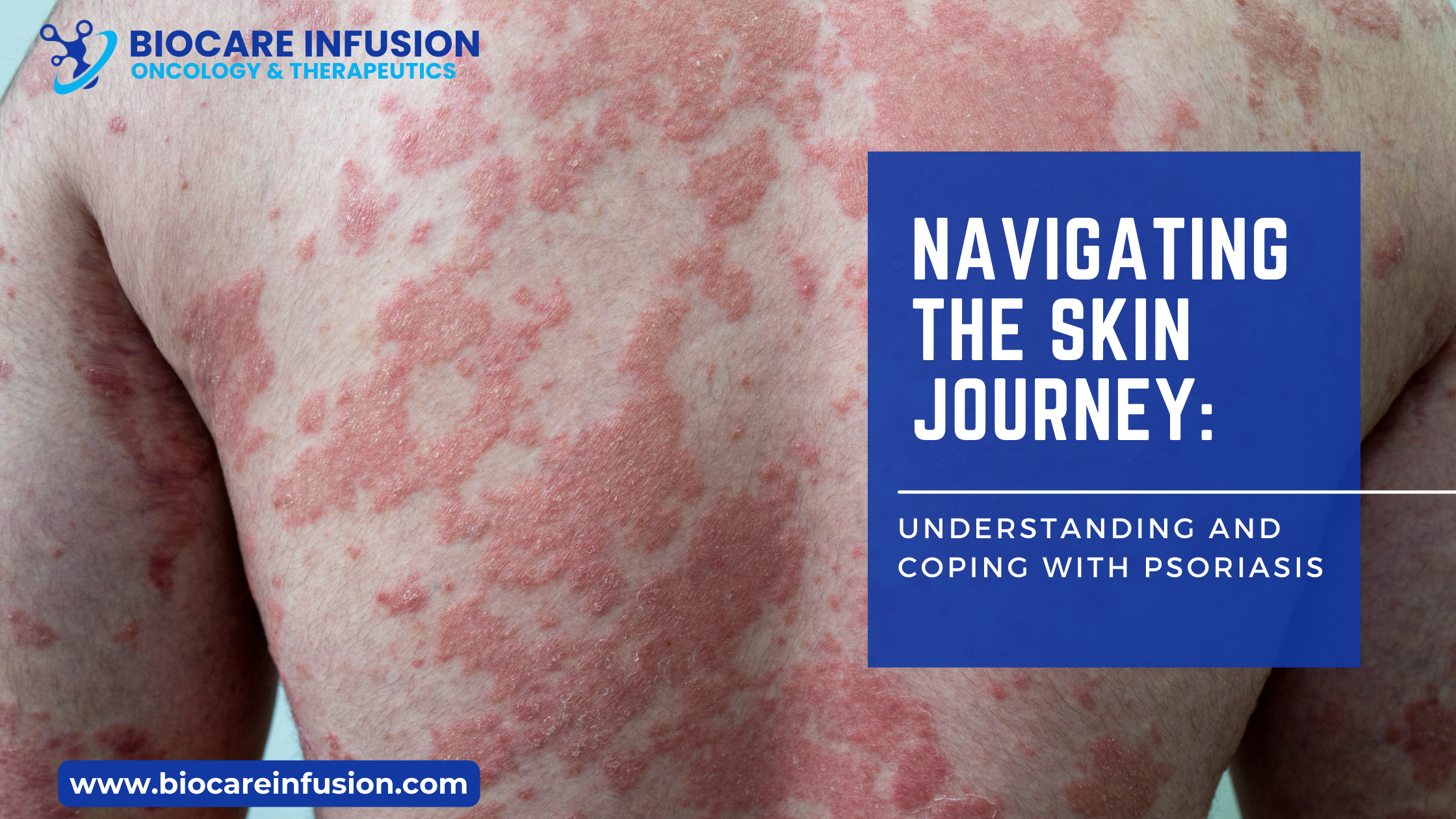 Navigating the Skin Journey: Understanding and Coping with Psoriasis ...